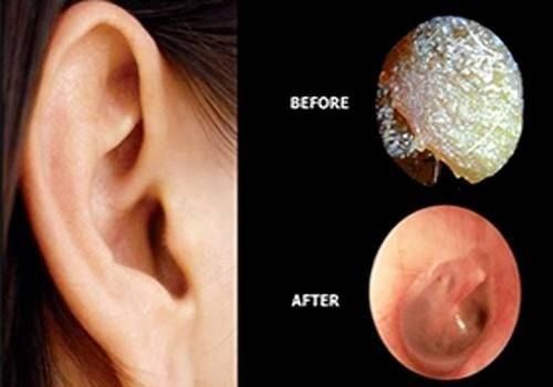 ear wax removal microsuction